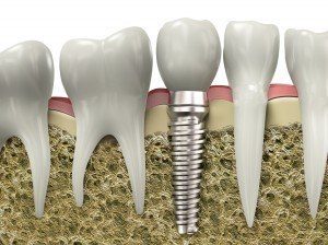 DentalInmplants-300x224
