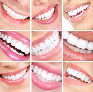 Tooth Whitening by Yokoyama Dentistry
