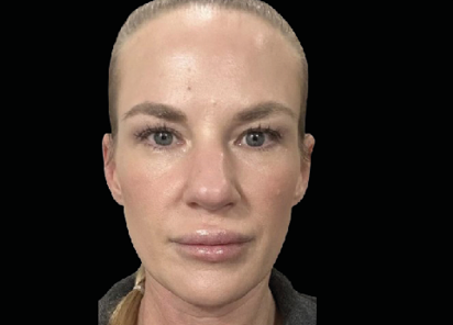 After EMFACE facial treatment