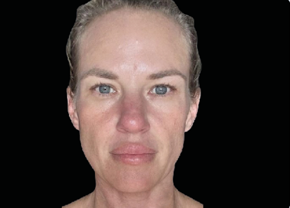 Before EMFACE facial treatment