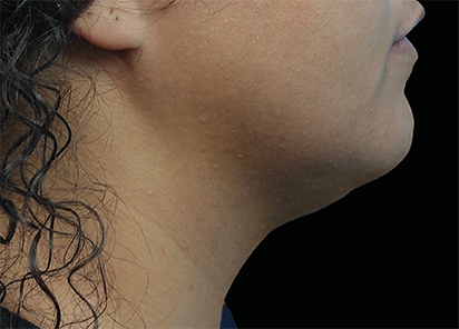 After EMFACE submentum treatment