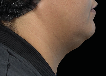 Before EMFACE submentum treatment